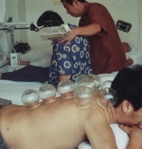 Cupping